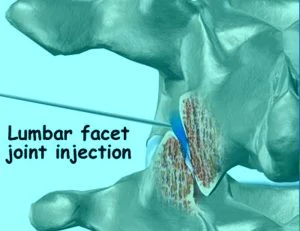 Facet joint and medial branch block injections
